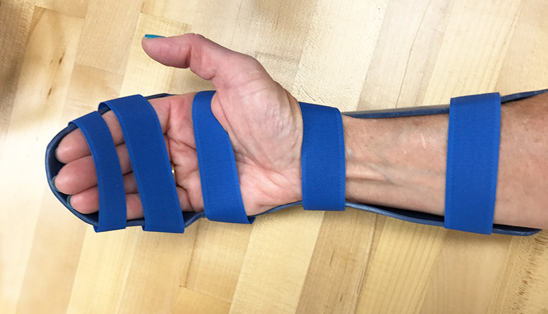 Dorsal blocking orthosis from Orfit thermoplastic.