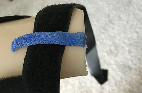 Loop strapping on a thermoplastic static progressive elbow flexion orthosis