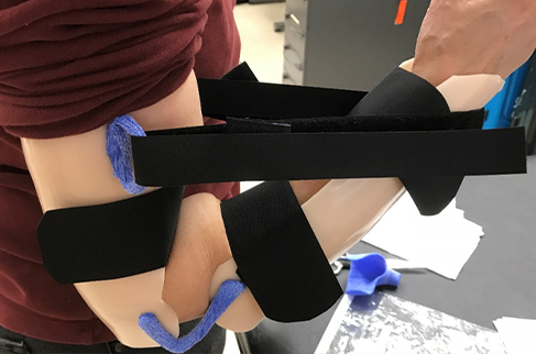 Woman wearing a static progressive elbow flexion orthosis in increased flexion.