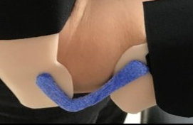 Blue Orficast hinge on a thermoplastic static progressive elbow flexion orthosis
