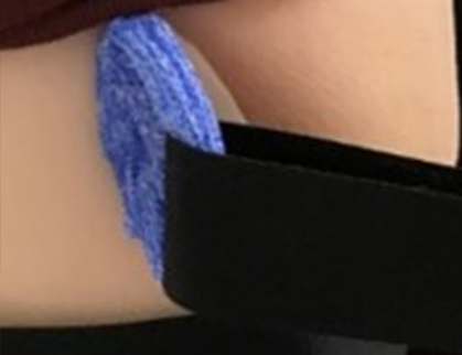 Blue Orficast loop on a thermoplastic static progressive elbow flexion orthosis