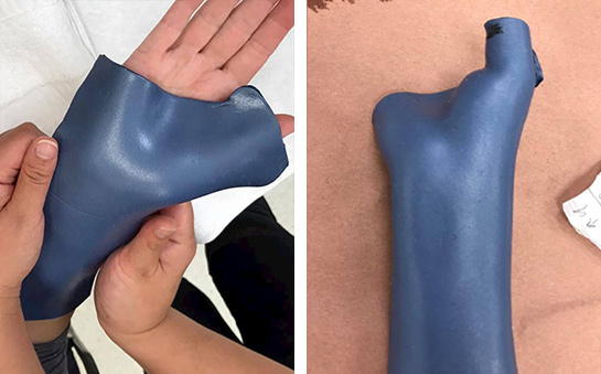 Moulding the orthosis on the patient's hand.