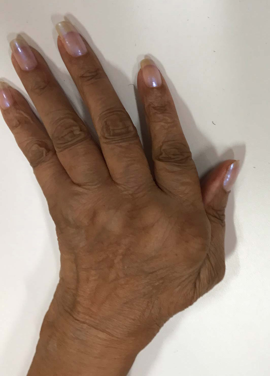 hand of a lady with rheumatoid arthritis